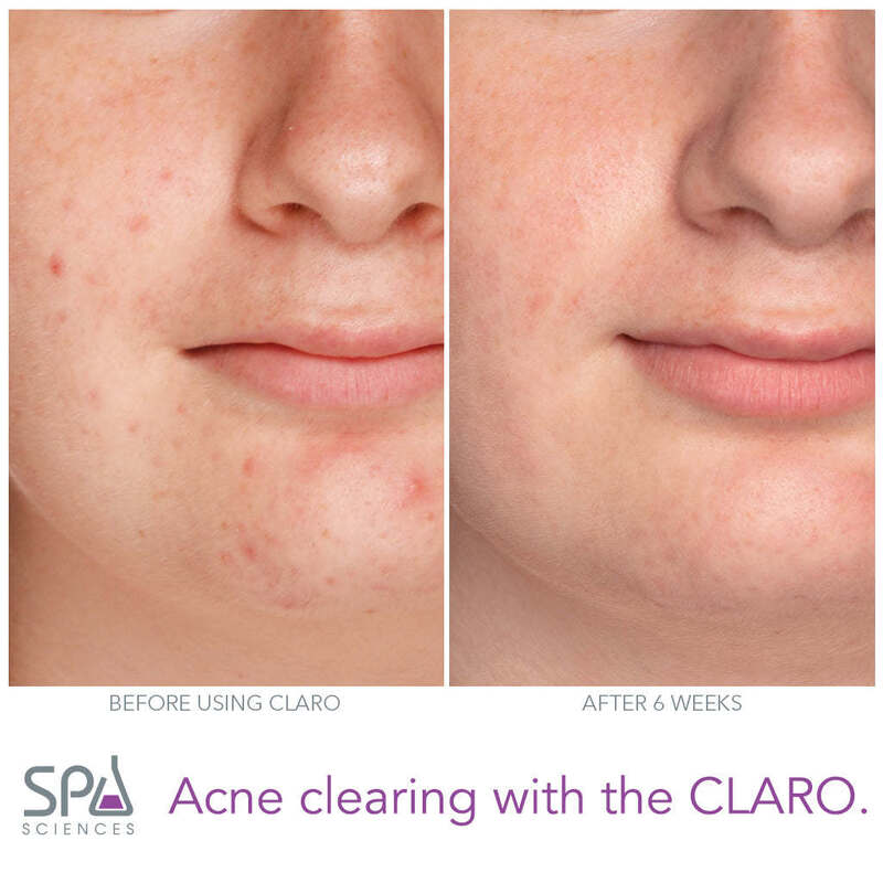 CLARO FDA Cleared Clinically Proven 2-in-1 Acne Clearing LED Light Therapy Device for Anti Aging