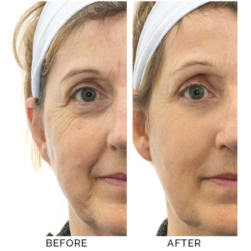 AERO Skincare Infusion Tool - 7x More Effective Absorption Anti-Aging Device for Reducing Fine Lines and Improving Skin Hydration