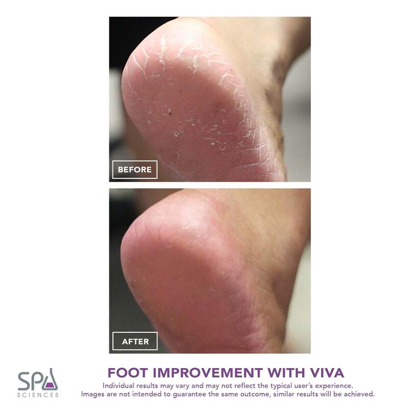 VIVA Rechargeable Skin Smoothing Device with Multi-disc System and 360-degree Rotating Treatment Head for Professional Pedicure Results